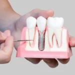 Advances in Dental Implant Technology