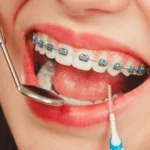 Cleaning Tips for Your Orthodontics